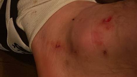 Max Kruses Fuß nach dem 2:2 von Wolfsburg in Gladbach