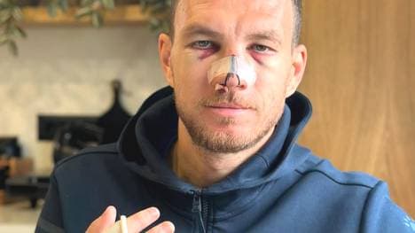 Edin Dzeko hat einiges abbekommen
