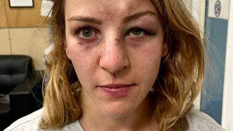 Margaux Pinot zeigte die schockierenden Bilder ihrer Wunden bei Twitter