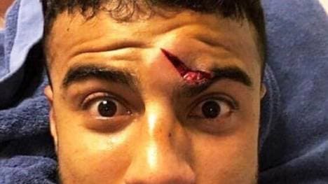 Rafinha muss vorerst mit einer Beule an seinem Schädel leben