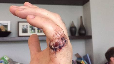 Jamie Donaldson machte Bekanntschaft mit einer Kettensäge 