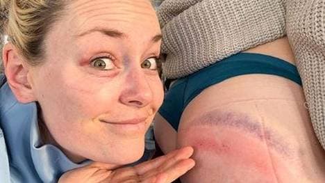 Lindsey Vonn und Laurenne Ross zeigen die Folgen ihrer Stürze