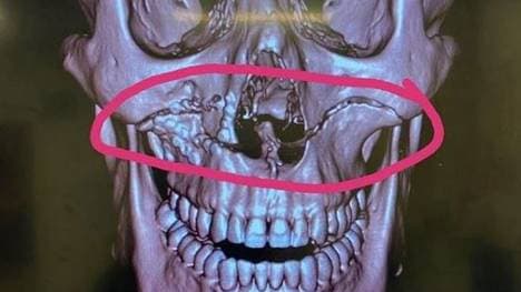 Sia Soliola hat sich beim Rugby den Oberkiefer zerschmettert