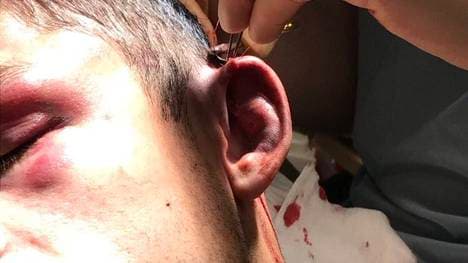 Bei Stephen Smiths Ohr ist alles wieder dort, wo es hingehört