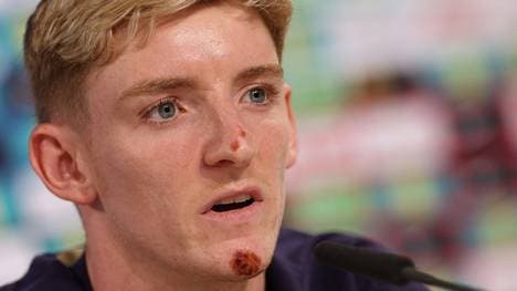 Anthony Gordon ist von seinem Fahrradsturz gezeichnet