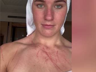 Wasserball gehört zu den härtesten Sportarten. Das bekam auch die Australierin Tilly Kearns zu spüren.