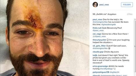 Simon Geschke mit seiner Narbe