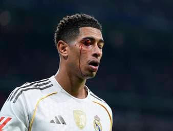 Plötzlich blutet Bellingham im Gesicht