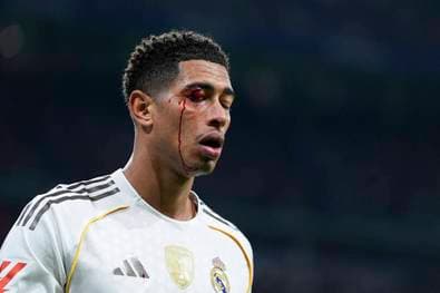 Plötzlich blutet Bellingham im Gesicht