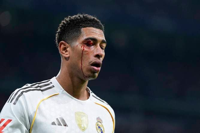 Plötzlich blutet Bellingham im Gesicht